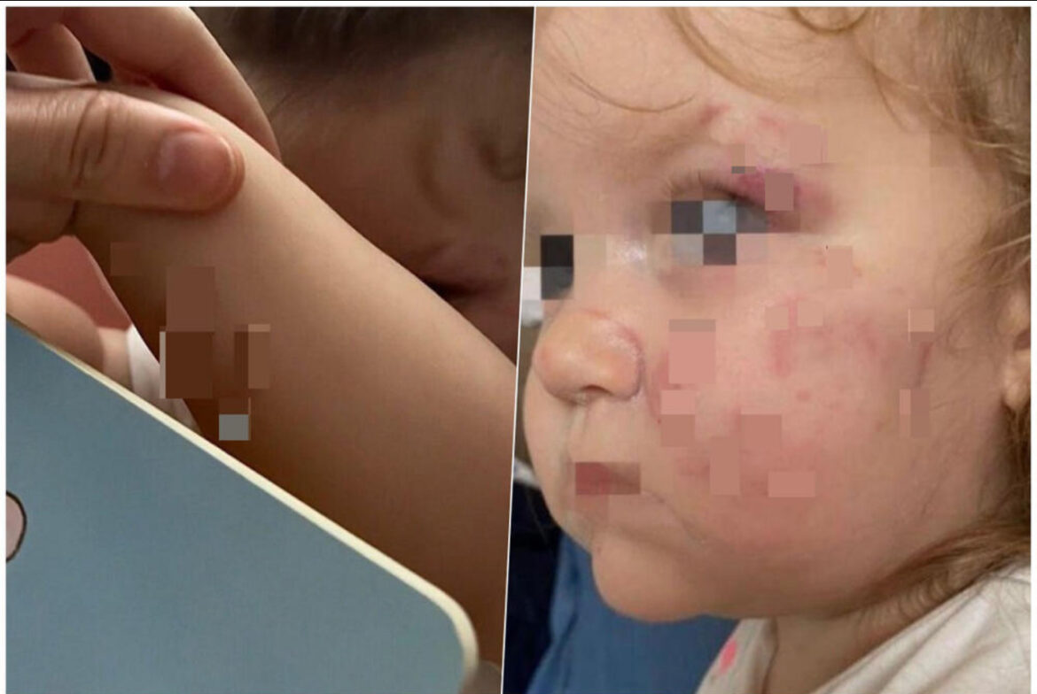 DETE IZUJEDALO VRŠNJAKINJU U VRTIĆU Užas u Sremskoj Mitrovici: Devojčica hitno hospitalizovana