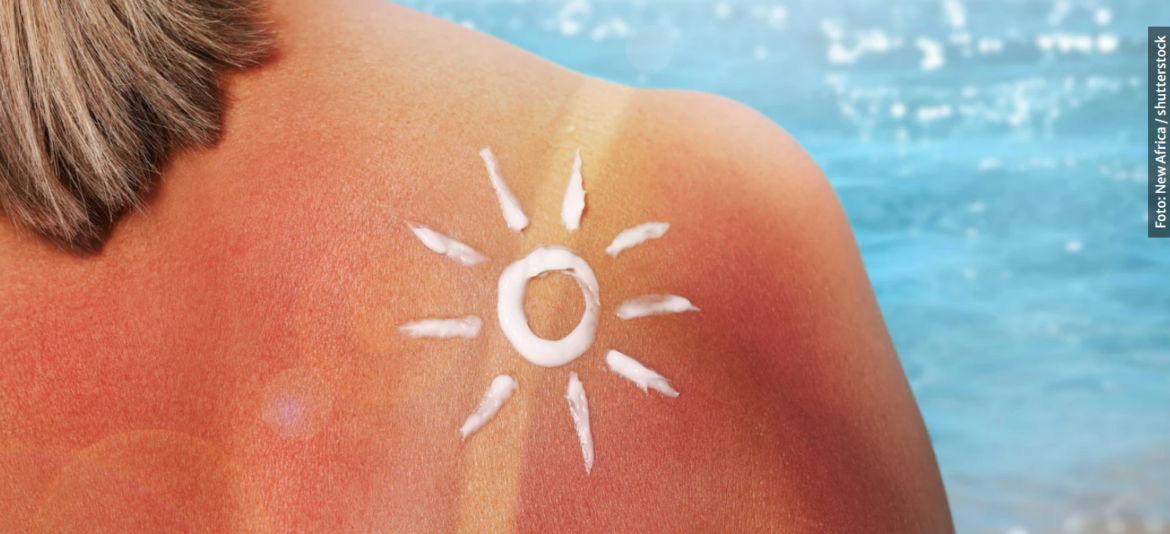 Tamniji ten nije štit: To što ne gorite na suncu, ne znači da ste imuni na rak kože, upozoravaju dermatolozi