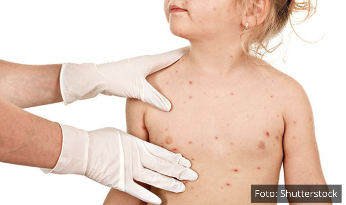 OPET PRETI EPIDEMIJA MORBILA: Roditelji iz straha od korone ne vode decu na obaveznu vakcinaciju!
