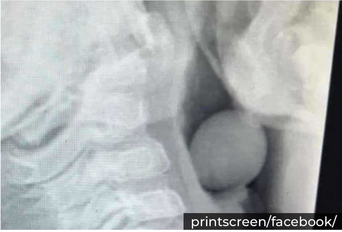 DEČAK ZAVRŠIO U HITNOJ: Šokantan rendgenski snimak pokazuje šta je progutao i počeo da se GUŠI! (FOTO)