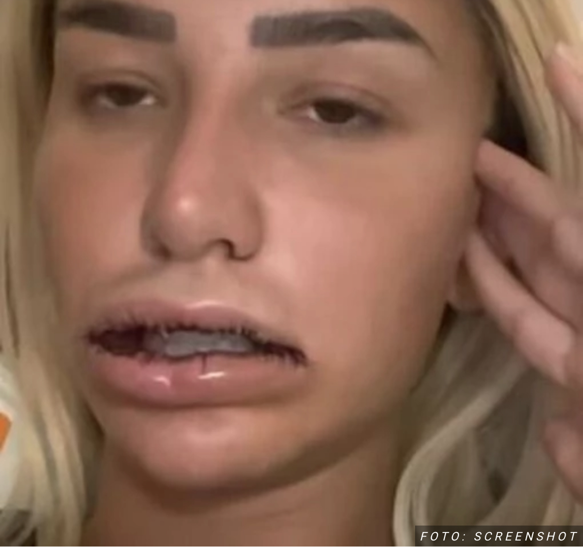 NA USNAMA SU I DALJE KONCI Aleks izvadila silikon iz usana, a evo kako sada izgleda – objavila selfije (FOTO)