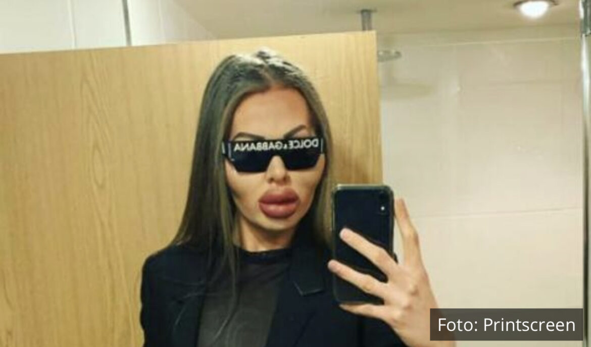 SALONI LEPOTE NEĆE VIŠE DA MU UBRIZGAVAJU FILERE, PA TO RADI SAM: Zna da usne mogu da mu PUKNU, ali ne može da se odupre ZAVISNOSTI
