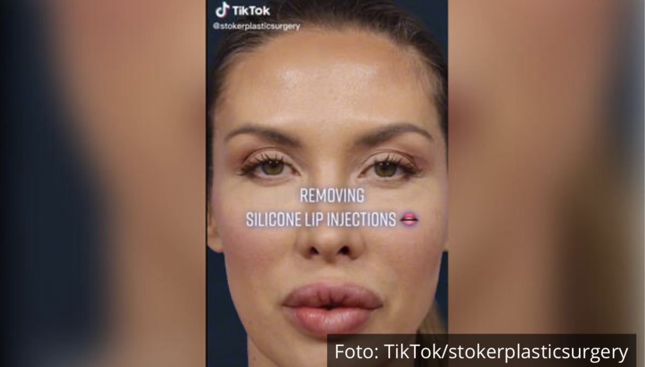 OVAKO IZGLEDA LICE KAD SE IZVADE SILIKONI: Prirodni izgled se&hellip;