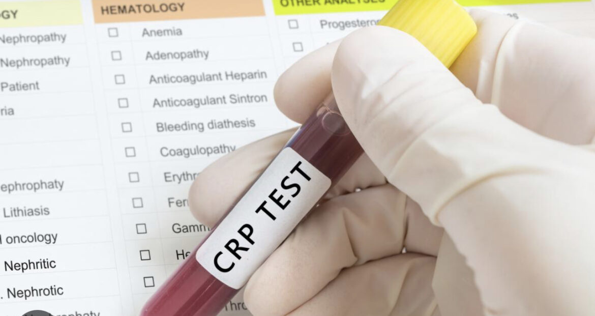 Zašto se radi CRP test i šta ova analiza može da otkrije