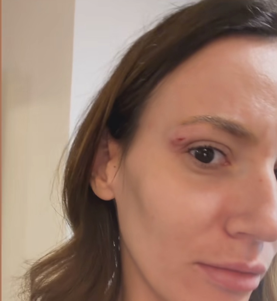 „Udario me, isekao“: Kristini Spalević pukla arkada, hitno se oglasila&hellip;